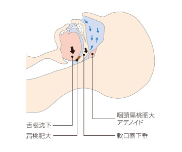 無呼吸の発生